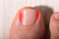 Is My Ingrown Toenail Infected?