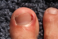 Everything You Wanted to Know About Ingrown Toenails