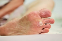 Why Do Plantar Warts Grow Inward?