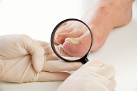 Ways to Treat Toenail Fungus