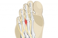 What Can Be Done About Morton’s Neuroma?