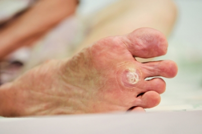 Plantar Warts Grow Inward